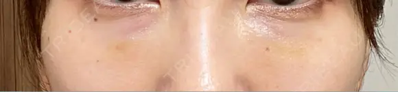 肌ヒアルロン酸注入（たるみ・シワ改善） しのぶ皮膚科 AFTER メイン用