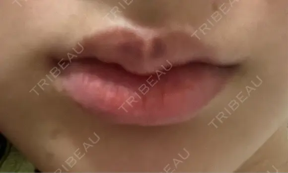 ヒアルロン酸注入（唇） 目白ホワイトクリニック DAY 3 メイン用