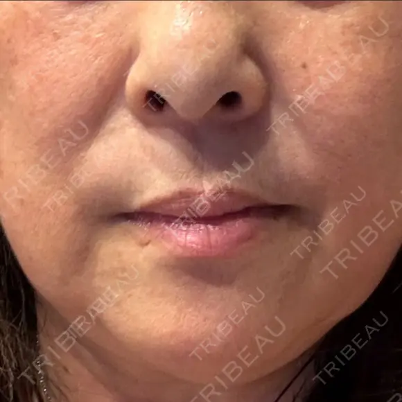 レーザートーニング（美白・肝斑） トラスト美容クリニック 銀座院 DAY 2 メイン用