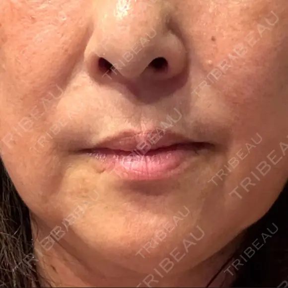 レーザートーニング（美白・肝斑） トラスト美容クリニック 銀座院 DAY 4 メイン用