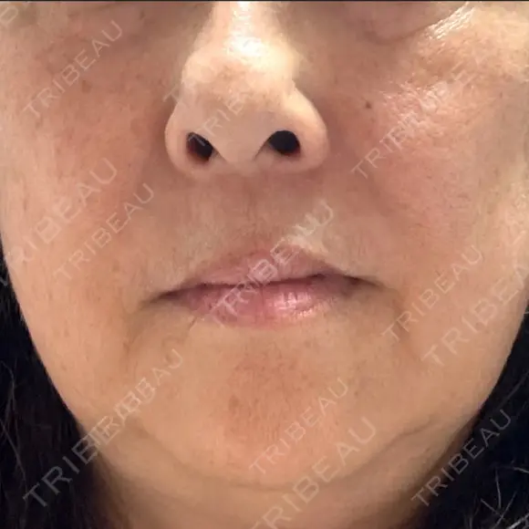 レーザートーニング（美白・肝斑） トラスト美容クリニック 銀座院 DAY 5 メイン用