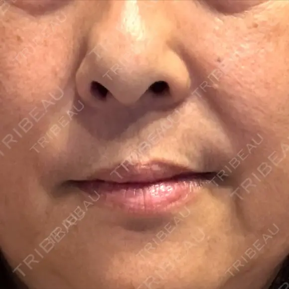 レーザートーニング（美白・肝斑） トラスト美容クリニック 銀座院 DAY 6 メイン用