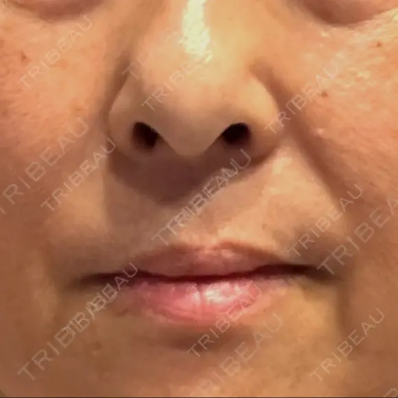 レーザートーニング（美白・肝斑） トラスト美容クリニック 銀座院 DAY 7 メイン用