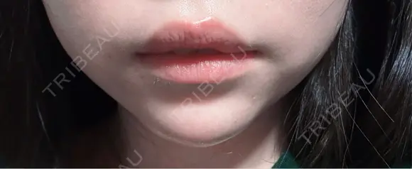 ボトックス（口角） AURORA CLINIC（オーロラクリニック）新宿院 DAY 0 メイン用