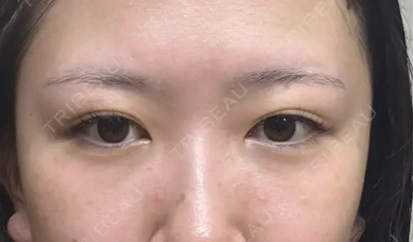 クマ治療 / 下まぶたたるみ取り / 下まぶたの脂肪取り APOLLO BEAUTY CLINIC AFTER メイン用