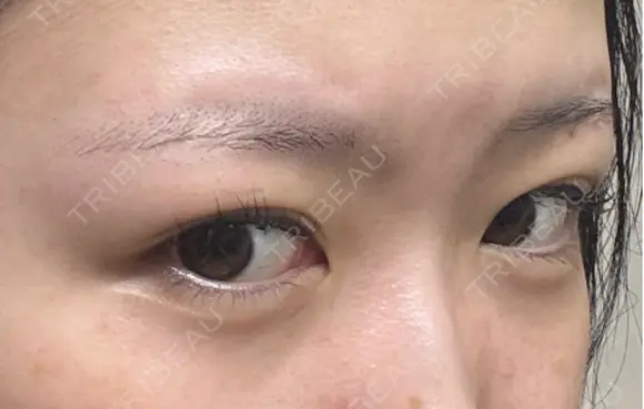 クマ治療 / 下まぶたたるみ取り / 下まぶたの脂肪取り APOLLO BEAUTY CLINIC DAY 30 メイン用