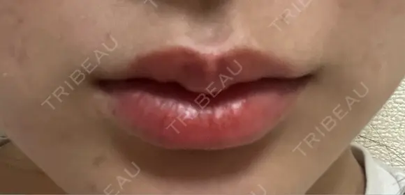 ヒアルロン酸注入（唇） 目白ホワイトクリニック DAY 4 メイン用