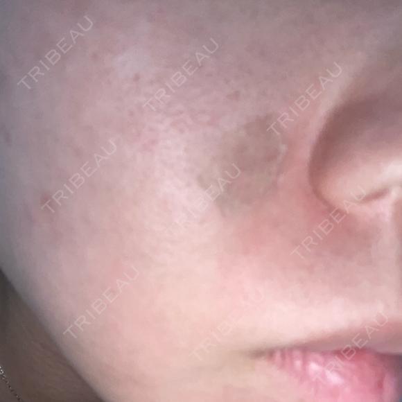 ほくろ・いぼ切除（肌） あいちビューティークリニック栄本院 DAY 2 メイン用