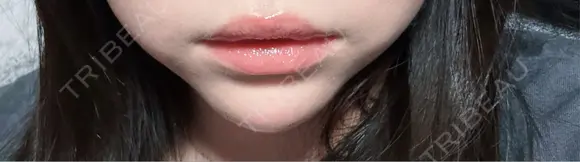 ボトックス（口角） AURORA CLINIC（オーロラクリニック）新宿院 AFTER メイン用