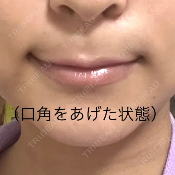 ボトックス（口角） J CLINIC DAY 0 メイン用