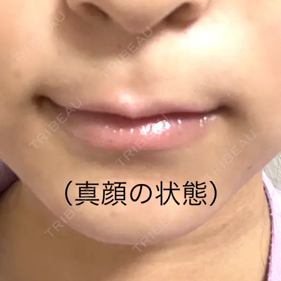 ボトックス（口角） J CLINIC DAY 0 メイン用