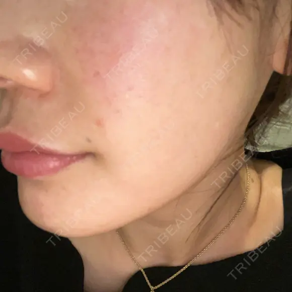 肌育注射（ジュベルックなど） / イオン導入 / ピーリング（ハリ・ツヤ） ゆう美容クリニック DAY 0 メイン用