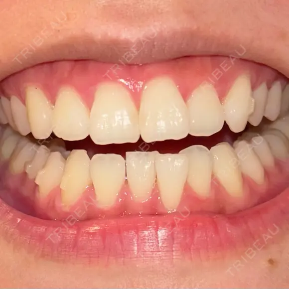 矯正（マウスピース） 湘南歯科クリニック 池袋院 DAY 47 メイン用