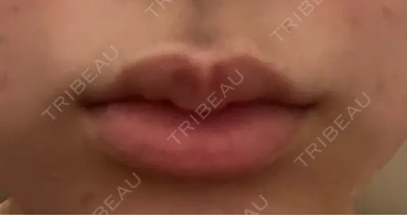 ヒアルロン酸注入（唇） 目白ホワイトクリニック DAY 5 メイン用