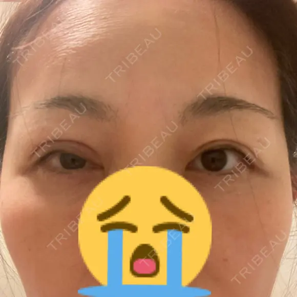 二重切開 水の森美容クリニック 大阪梅田院 AFTER メイン用