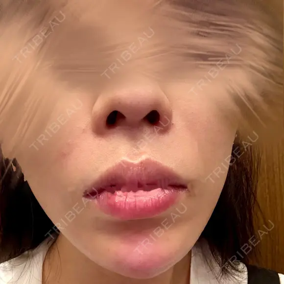 ボトックス（あご） / 肌ヒアルロン酸注入（たるみ・シワ改善） plume clinic DAY 0 メイン用