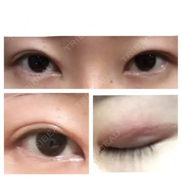 二重切開 表参道スキンクリニック 表参道院 DAY 84 メイン用