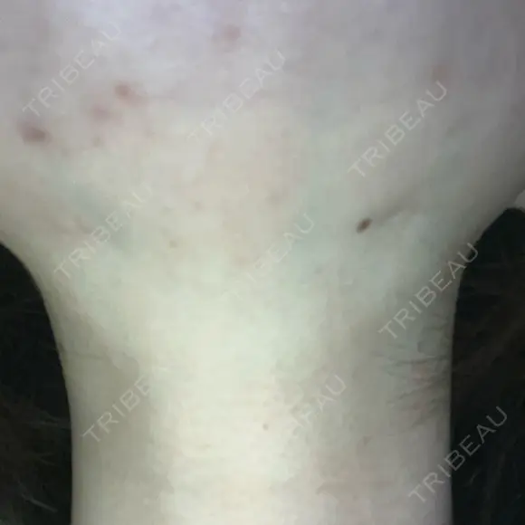 ハイフ（顔） S-Laboクリニック 渋谷院 AFTER メイン用