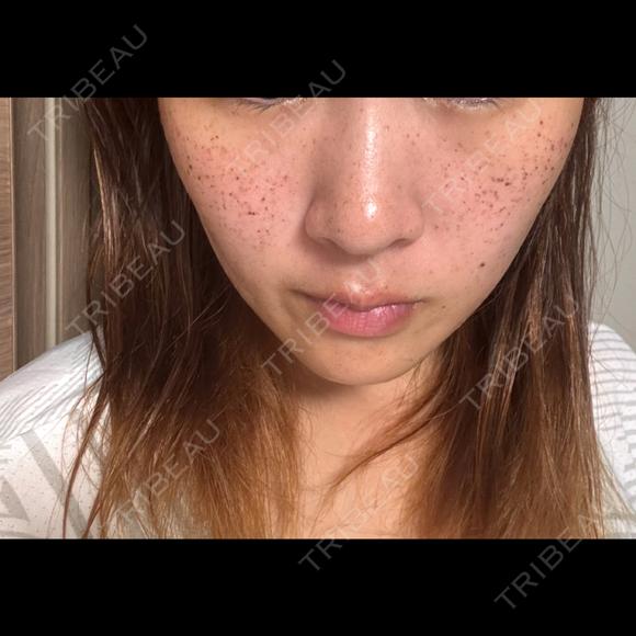 ピーリング（ニキビ・毛穴） / ルメッカ ルラ美容クリニック 横浜院 AFTER メイン用