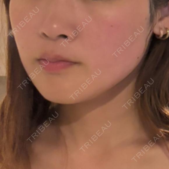 ピーリング（ニキビ・毛穴） / ルメッカ ルラ美容クリニック 横浜院 DAY 0 メイン用