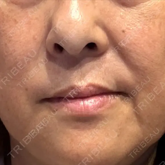 レーザートーニング（美白・肝斑） トラスト美容クリニック 銀座院 DAY 8 メイン用