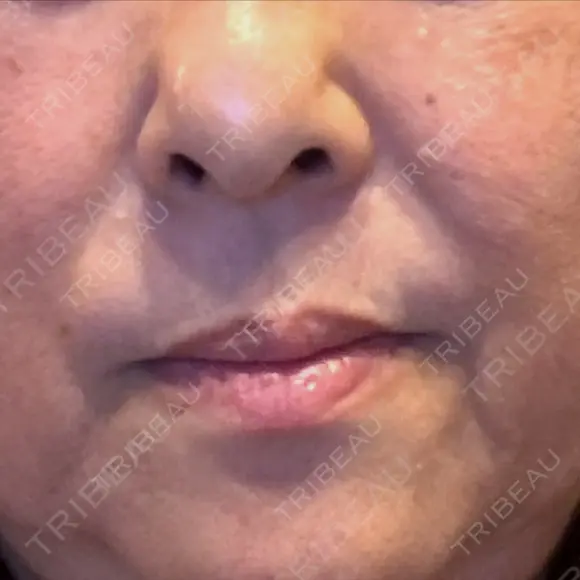 レーザートーニング（美白・肝斑） トラスト美容クリニック 銀座院 AFTER メイン用