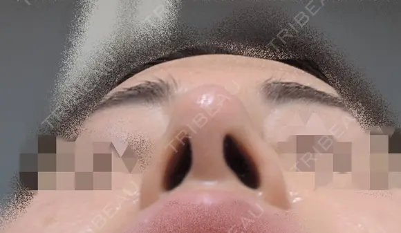 鼻尖縮小 / ヒアルロン酸注入（鼻） 東京ヒルズクリニック 銀座院 DAY 5 メイン用