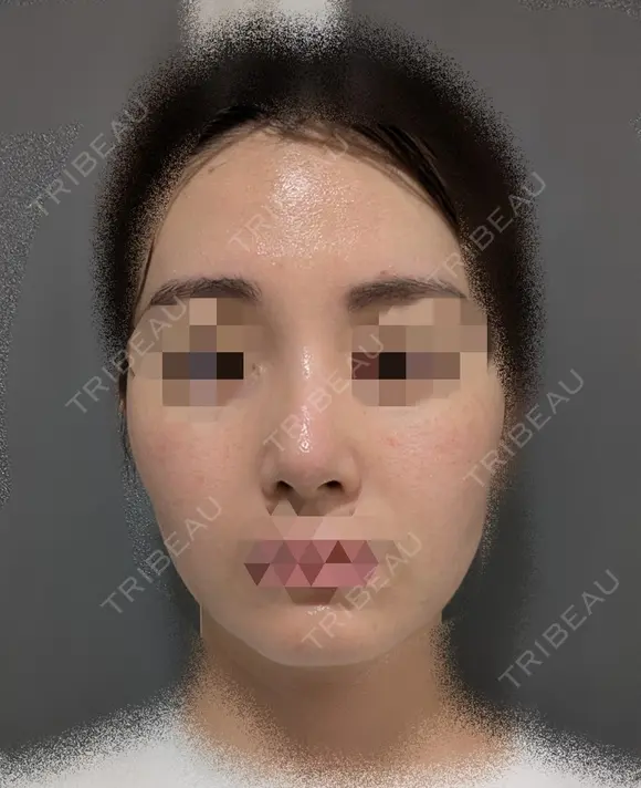 鼻尖縮小 / ヒアルロン酸注入（鼻） 東京ヒルズクリニック 銀座院 DAY 5 メイン用