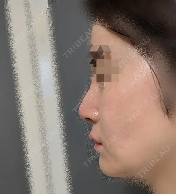 鼻尖縮小 / ヒアルロン酸注入（鼻） 東京ヒルズクリニック 銀座院 DAY 5 メイン用