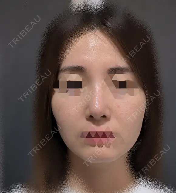 鼻尖縮小 / ヒアルロン酸注入（鼻） 東京ヒルズクリニック 銀座院 DAY 7 メイン用