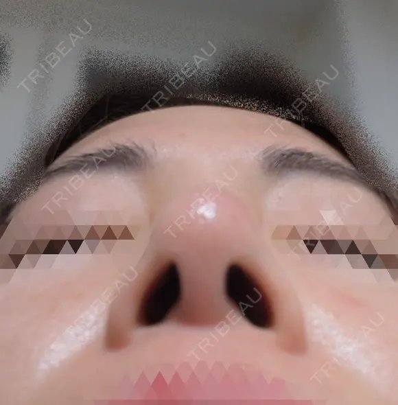 鼻尖縮小 / ヒアルロン酸注入（鼻） 東京ヒルズクリニック 銀座院 DAY 7 メイン用