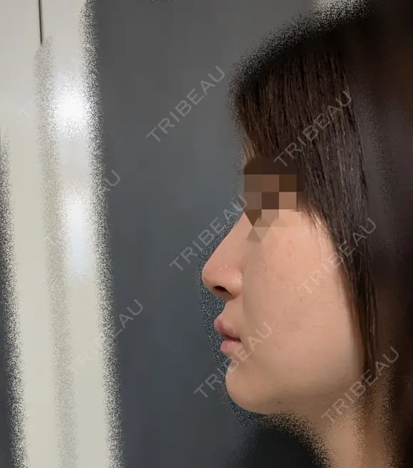 鼻尖縮小 / ヒアルロン酸注入（鼻） 東京ヒルズクリニック 銀座院 DAY 7 メイン用