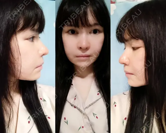 鼻修正 / 切開リフト / 鼻翼基部形成（貴族手術） リッツ美容外科 東京院 AFTER メイン用