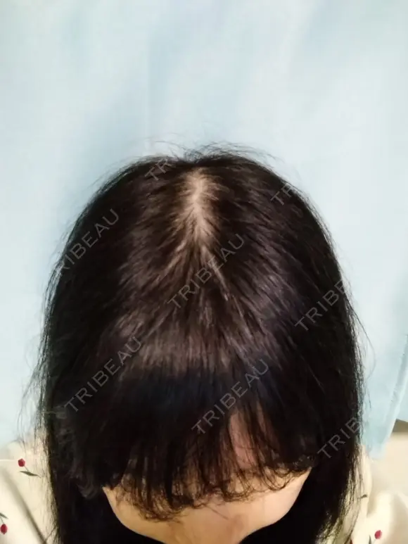 鼻修正 / 切開リフト / 鼻翼基部形成（貴族手術） リッツ美容外科 東京院 DAY 159 メイン用