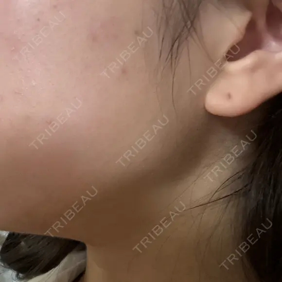 RF（高周波）たるみ治療 Wing clinic 豊中駅前院 DAY 2 メイン用