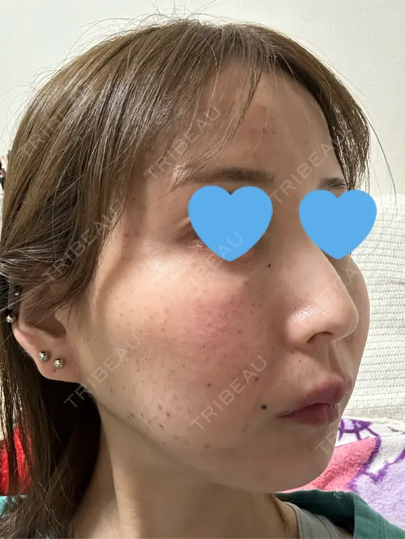 水光注射（ハリ・美肌） ちぐさ内科クリニック 覚王山 DAY 0 メイン用
