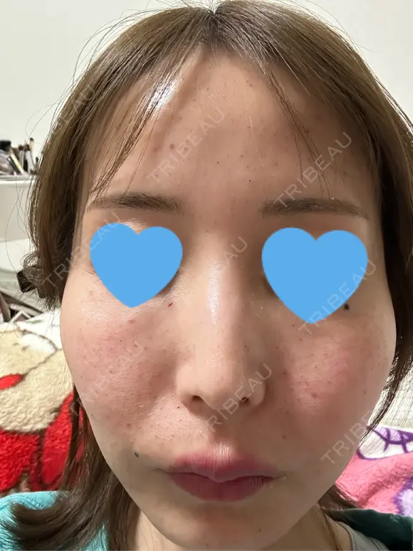 水光注射（ハリ・美肌） ちぐさ内科クリニック 覚王山 DAY 0 メイン用