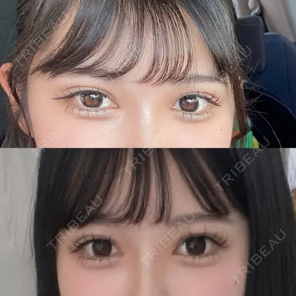 二重埋没 / RF（高周波）たるみ治療 Wing clinic 豊中駅前院 AFTER メイン用