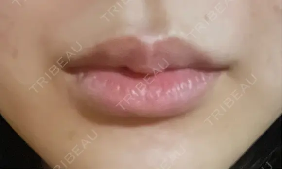 ヒアルロン酸注入（唇） 目白ホワイトクリニック DAY 8 メイン用