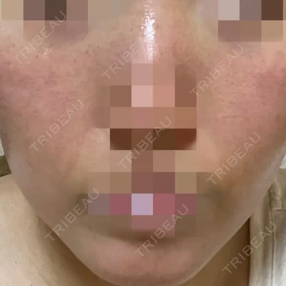 ポテンツァ ルラ美容クリニック 岡山院 DAY 0 メイン用