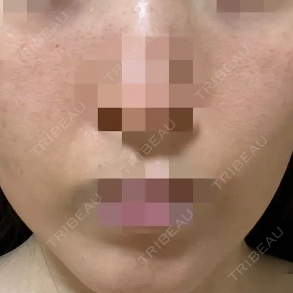 ポテンツァ ルラ美容クリニック 岡山院 AFTER メイン用