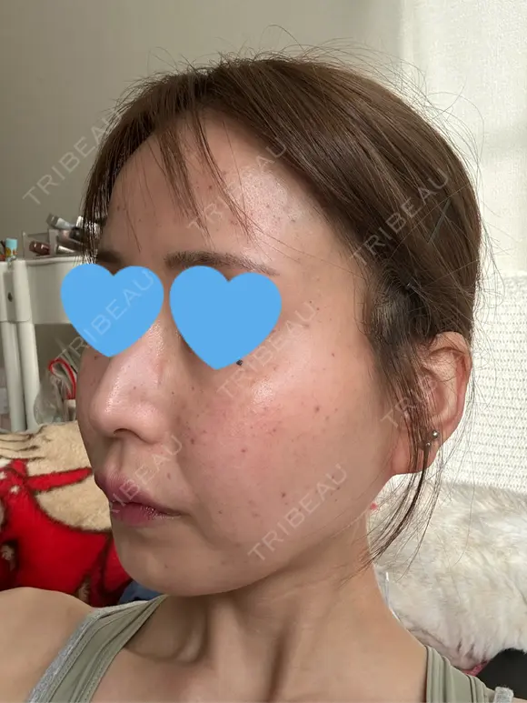 水光注射（ハリ・美肌） ちぐさ内科クリニック 覚王山 AFTER メイン用