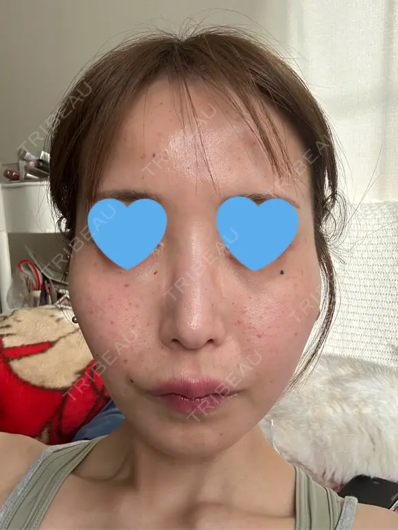 水光注射（ハリ・美肌） ちぐさ内科クリニック 覚王山 DAY 1 メイン用