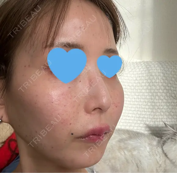 水光注射（ハリ・美肌） ちぐさ内科クリニック 覚王山 DAY 1 メイン用