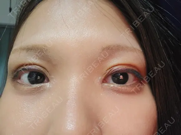 二重切開 / 目頭切開 / 上まぶたたるみ取り アリエル美容クリニック 大宮院 DAY 10 メイン用