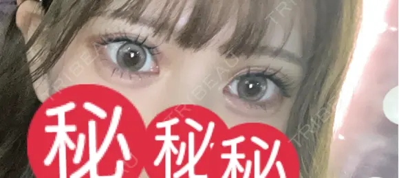 ヒアルロン酸注入（唇） / ヒアルロン酸注入（鼻翼基部） / その他（鼻） / その他（口元） 銀座美容外科クリニック 銀座院 AFTER メイン用