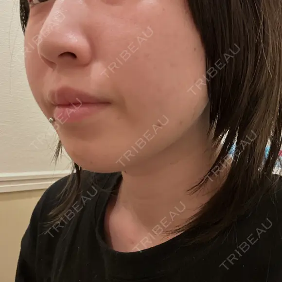 ボトックス（エラ・小顔） 東京シルククリニック 新宿院 DAY 1 メイン用