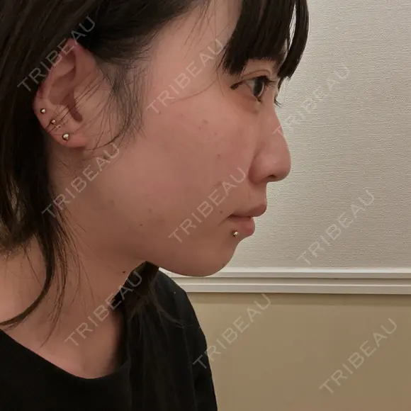 ボトックス（エラ・小顔） 東京シルククリニック 新宿院 DAY 1 メイン用