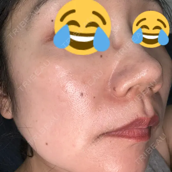イオン導入 / レーザートーニング（美白・肝斑） Kinshicho Beauty Clinic （錦糸町ビューティークリニック） AFTER メイン用