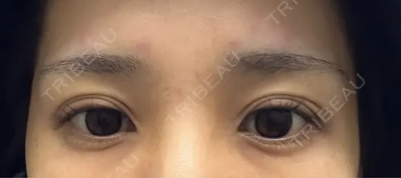 ボトックス（あご） / ボトックス（エラ・小顔） / ボトックス（口角） / ボトックス（眉間） Belle Via Skin Clinic DAY 0 メイン用
